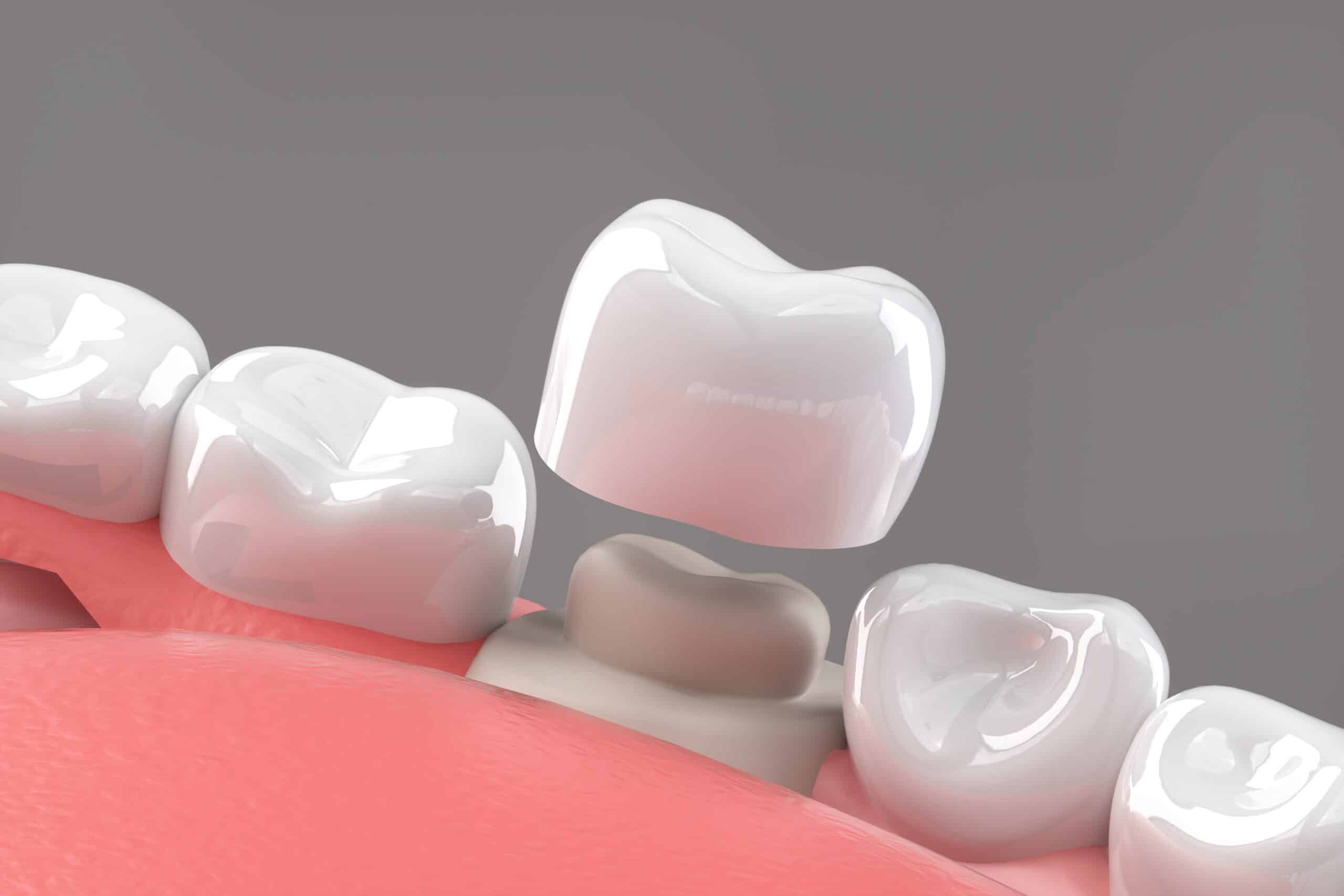 Dental Crowns New Braunfels